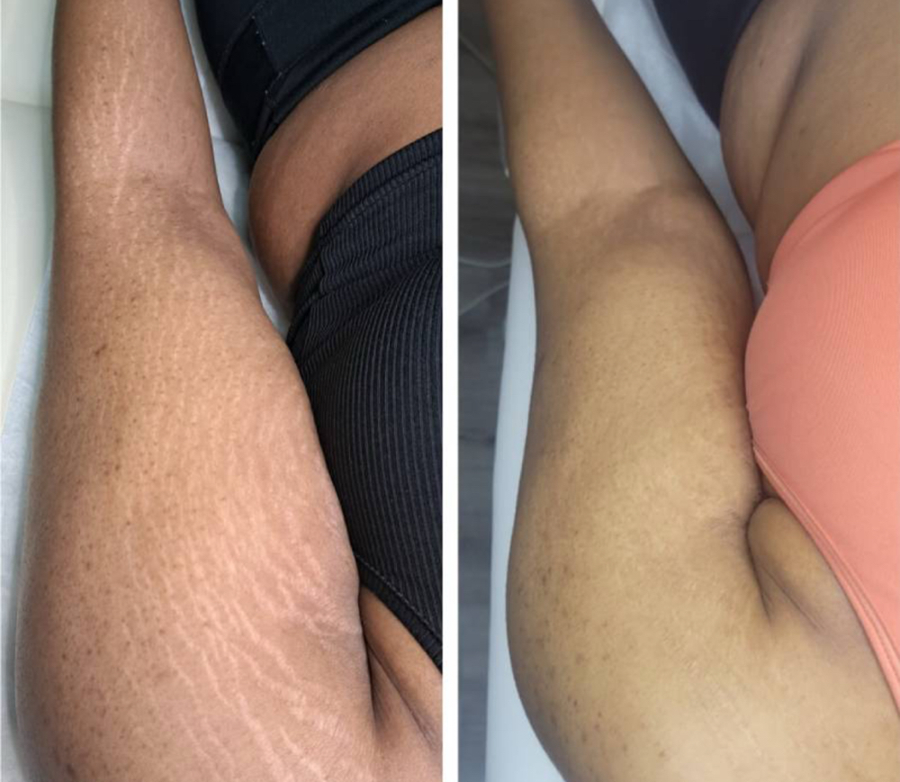 Inkless Serum Stretch Mark Therapy