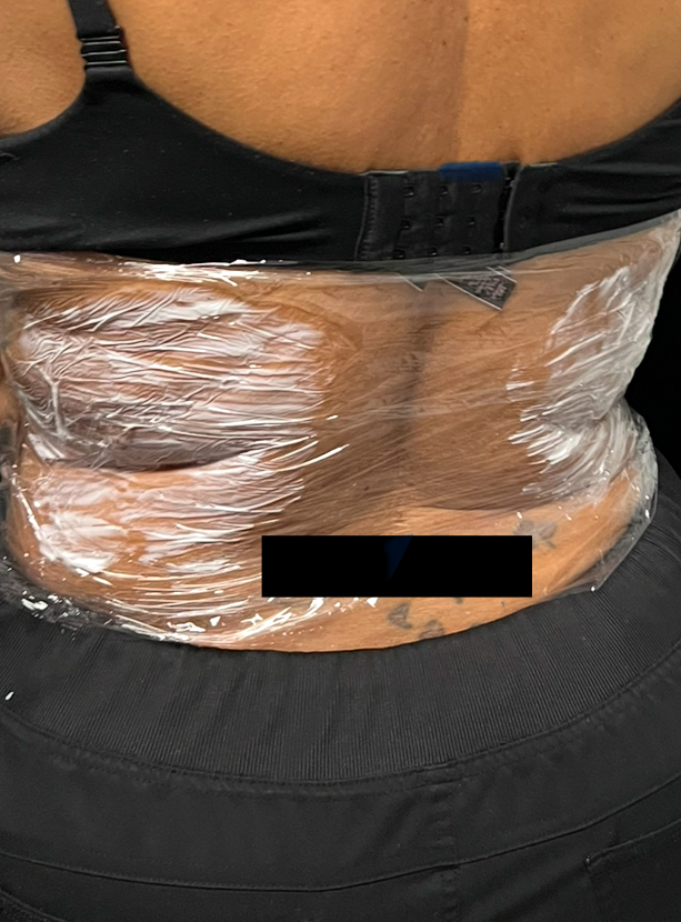 Mesotherapy, liquid Lipo