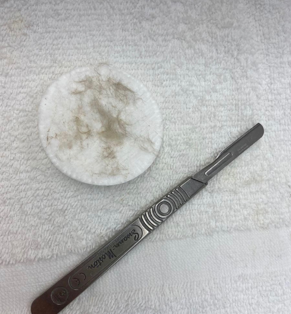 Dermplaning