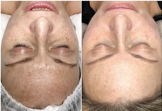 Triple Transformation Peel