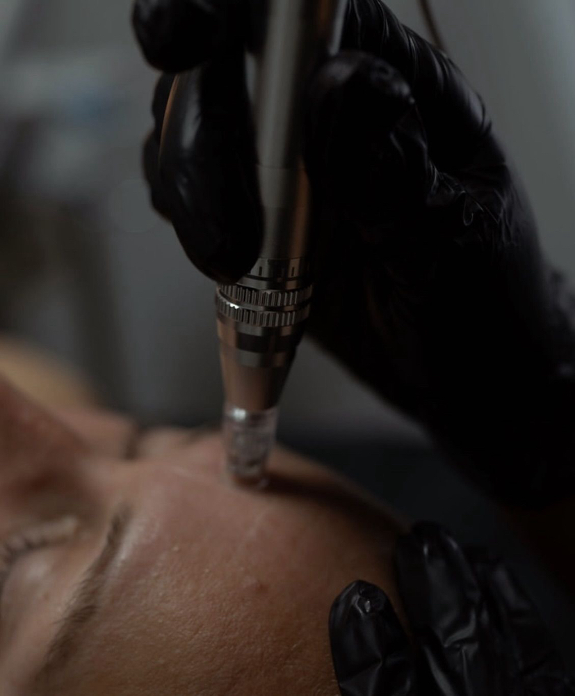 Micro-needling