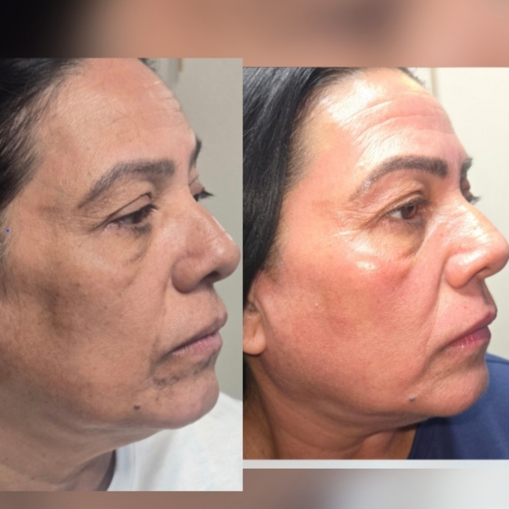 Procell Microchanneling Collagen at CANELA STUDIO in CLIFTON PARK, NY