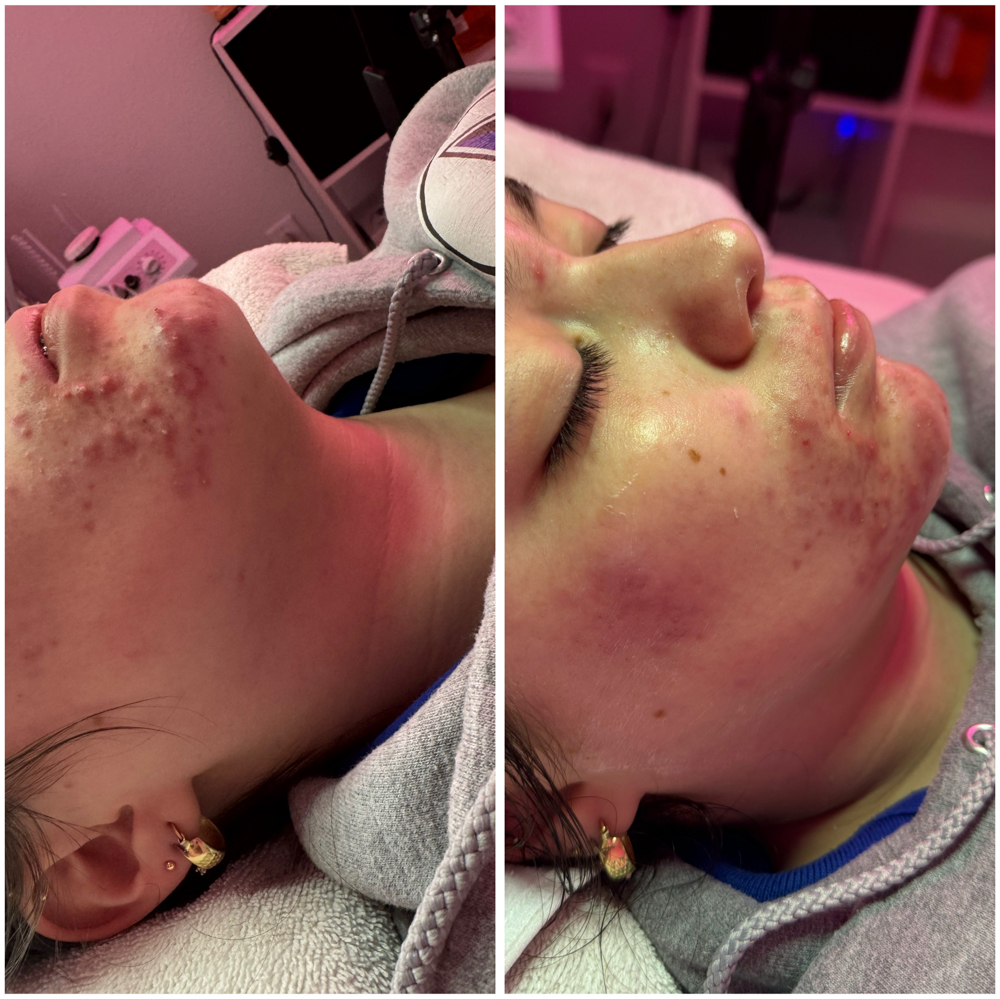 LA Rx Acne Reset 2.0