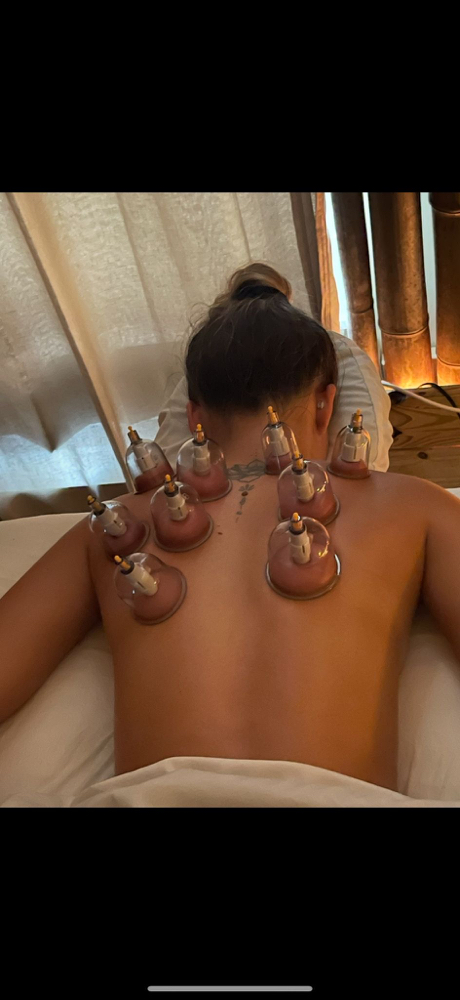 Cupping Therapy