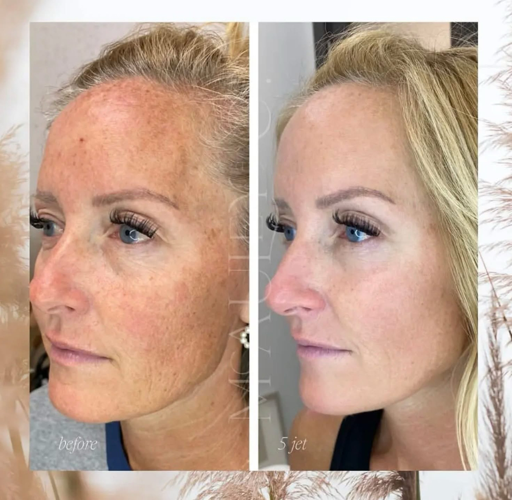 Jet Plasma Treatment Series Of 6