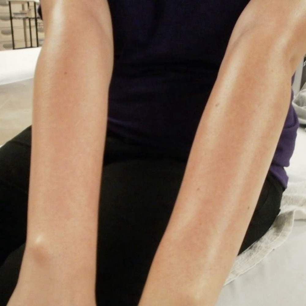 Full Arm Wax at Pearly Derm in Sun valley, CA