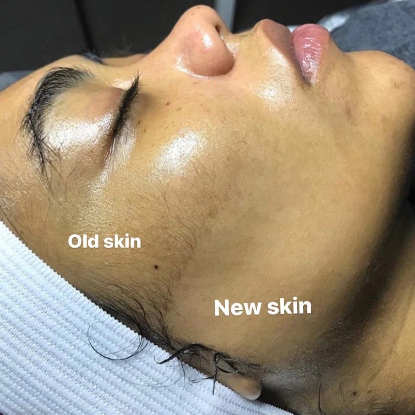 Dermaplaning at RAÍZ in Whittier, CA