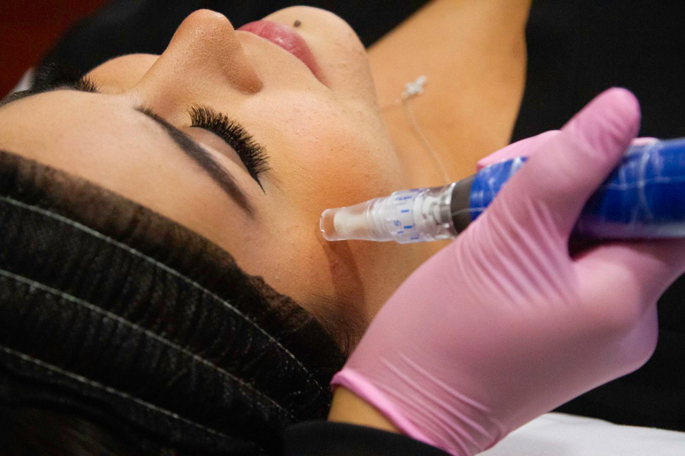 Skinpen Microneedling