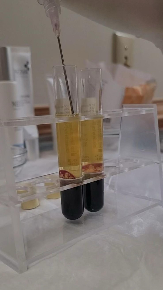 PRP Facial (Platelet-Rich Plasma) at Lalueurdejane in Miami, FL