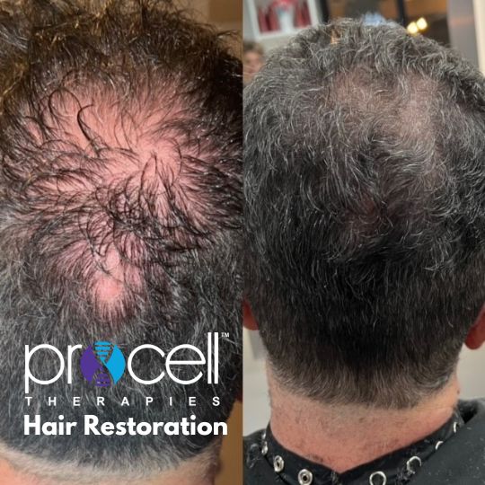 Microchannel/Microneedle-Full Scalp
