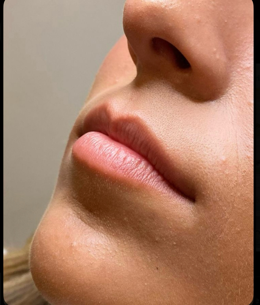 Upper lip at Skinhours in Kenilworth, NJ