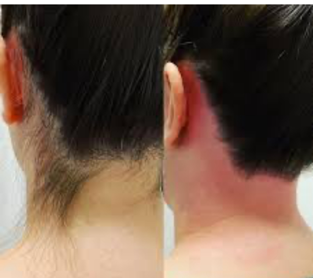 Hairline/ Back Of Neck