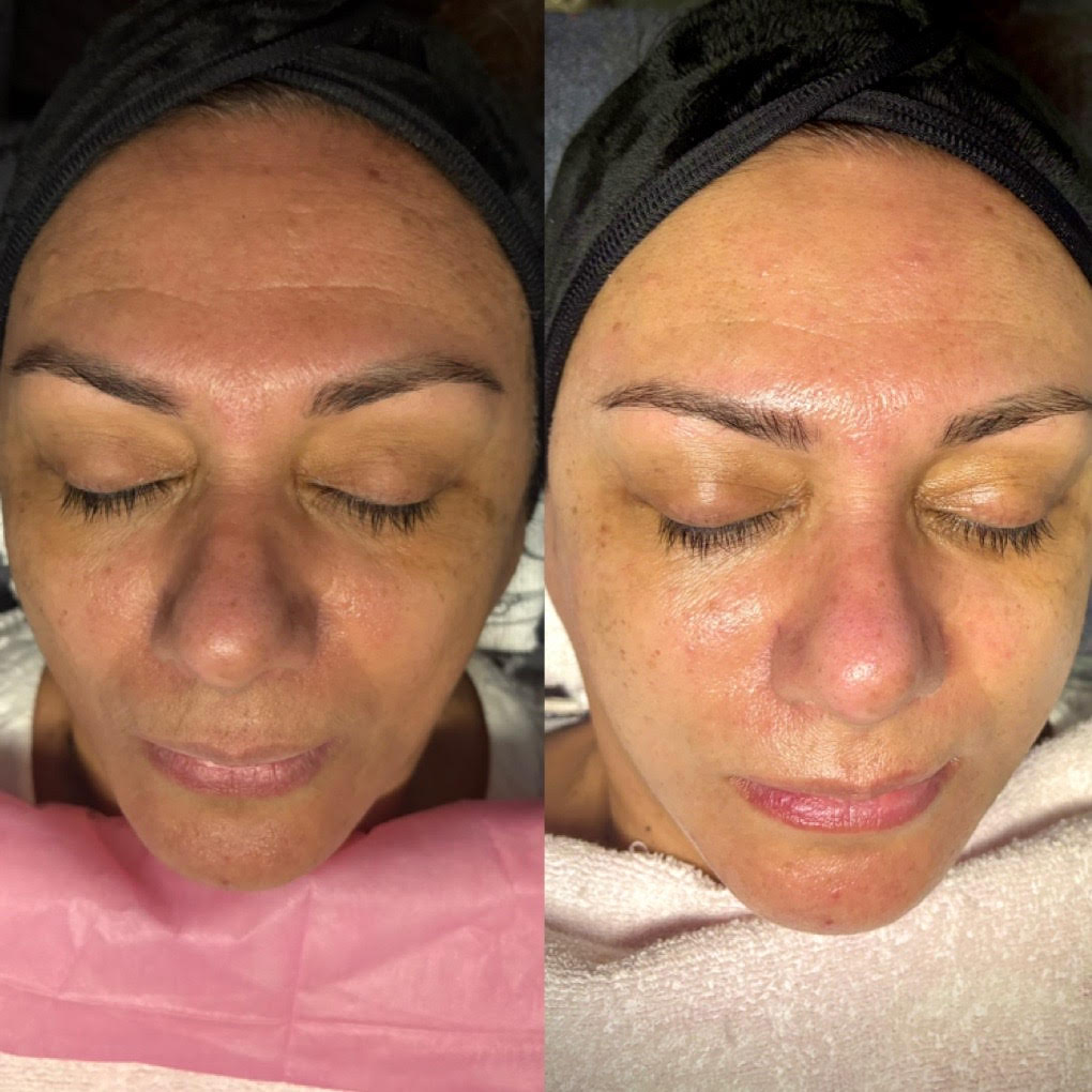 Collagen Rejuvenation Facial