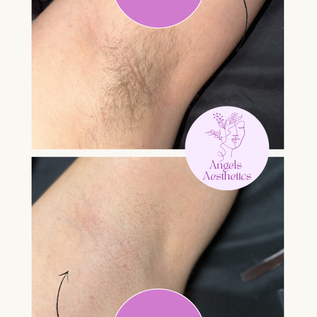 Underarm Wax at Angels Aesthetics ABQ in Albuquerque, NM