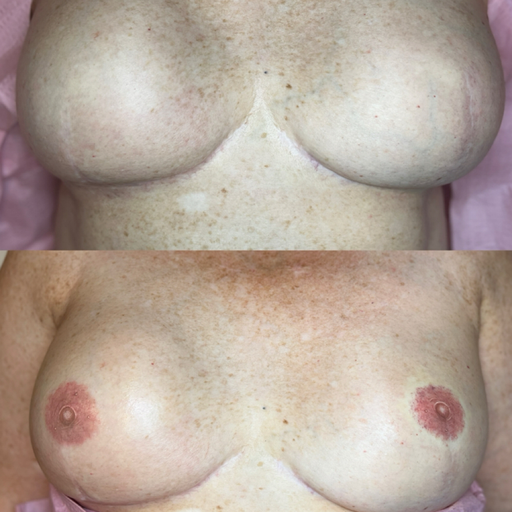 3D Areola Tattoo at Sharpe Brows in Quincy, IL