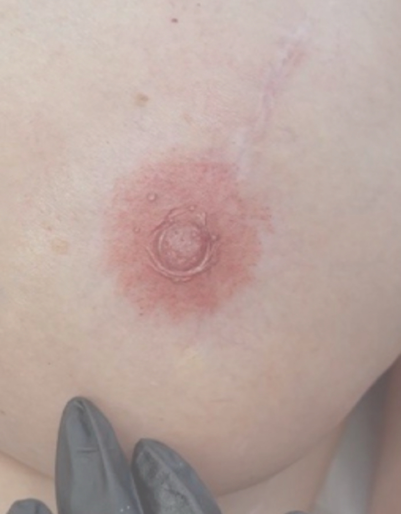 3D Areola Tattoo-Consultation First