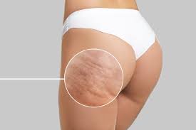 CelluliteVanish Virtual Mesotherapy