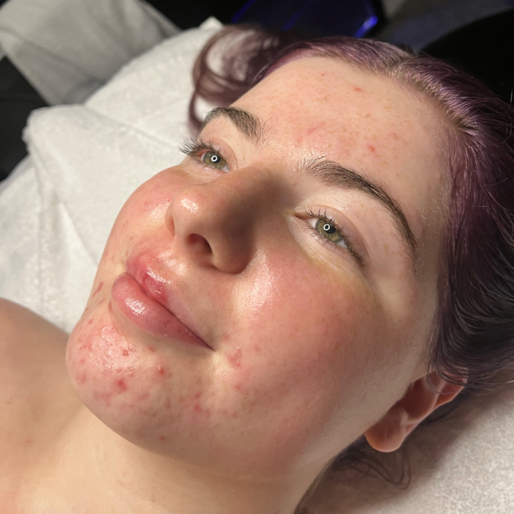 Acne Treatment Facial at Botanical Beauty Bar in Austin, TX