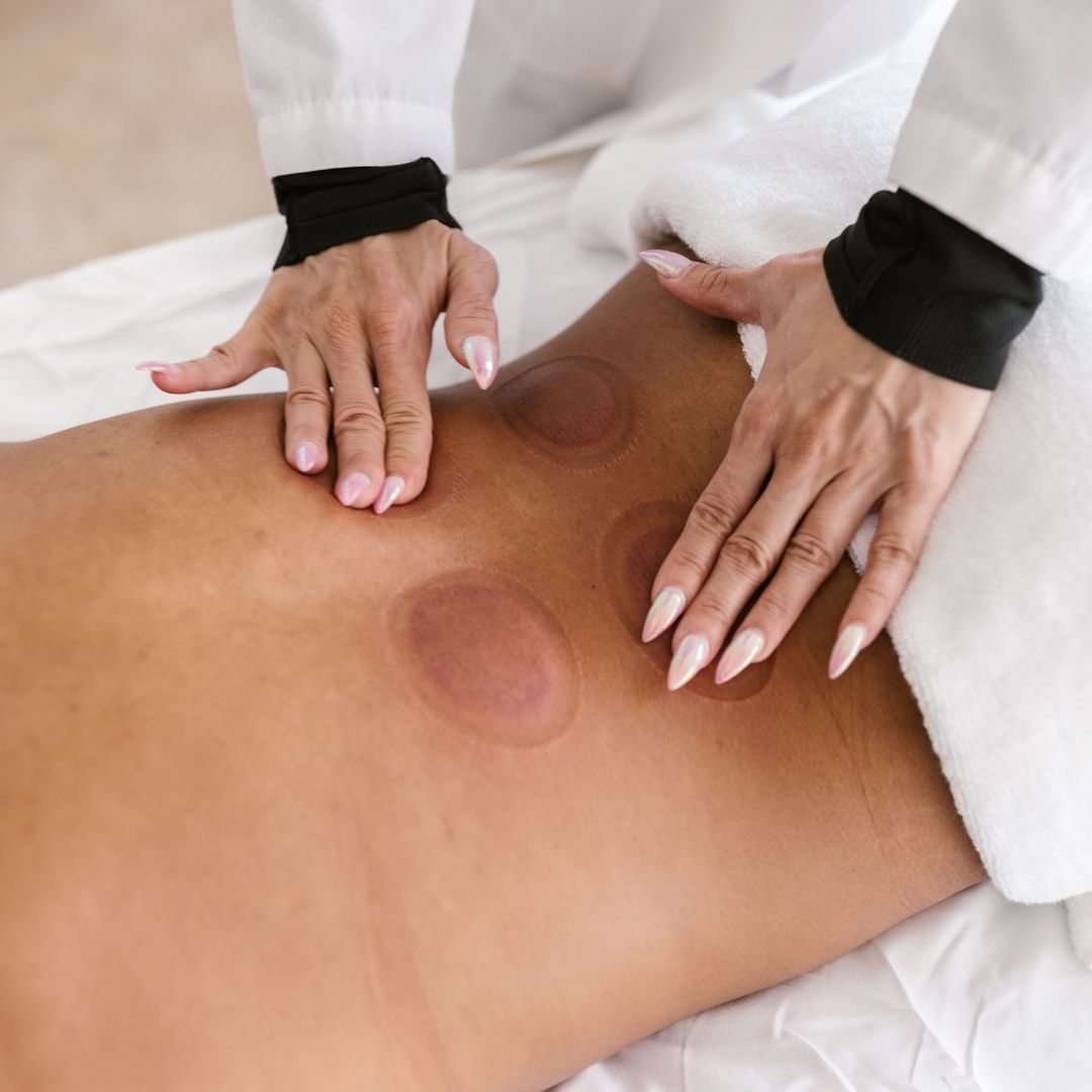 Cupping Therapy