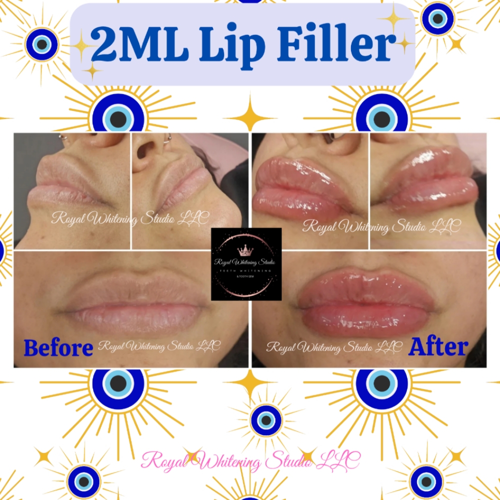 2ML Needle-less Lip Filler at Royal Whitening Studio LLC in Copperas Cove, TX