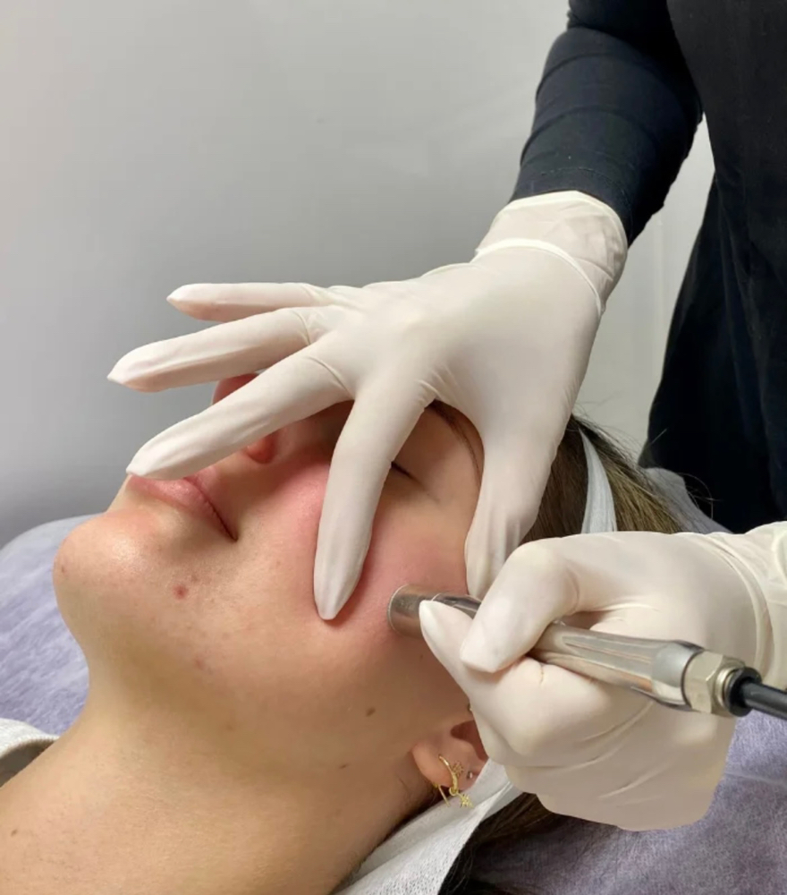 Fluid Diamond Microdermabrasion