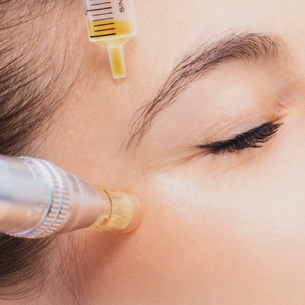 Microneedling at Aries Beauty & Wellness in Chandler, AZ