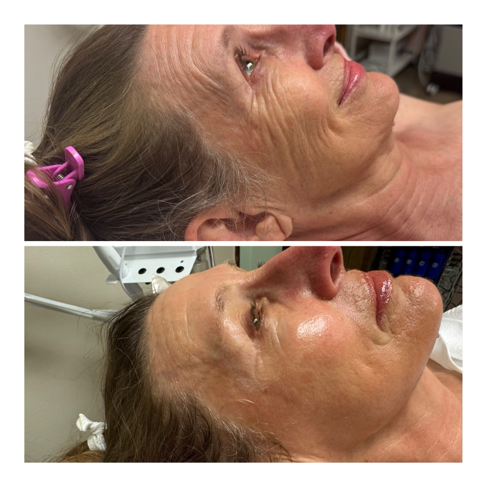 Luxe Lift Facial