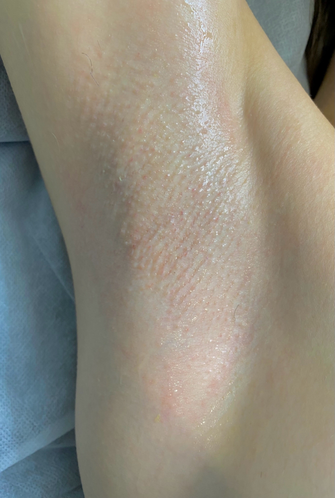 Sugaring - Underarms