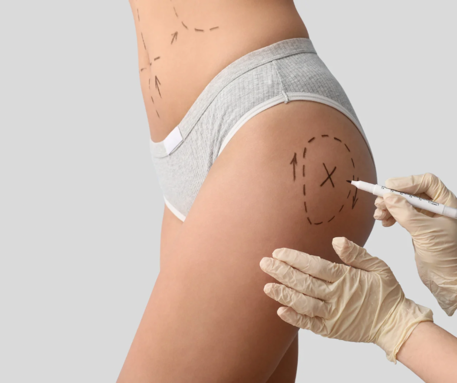Needle-Free Body Filler