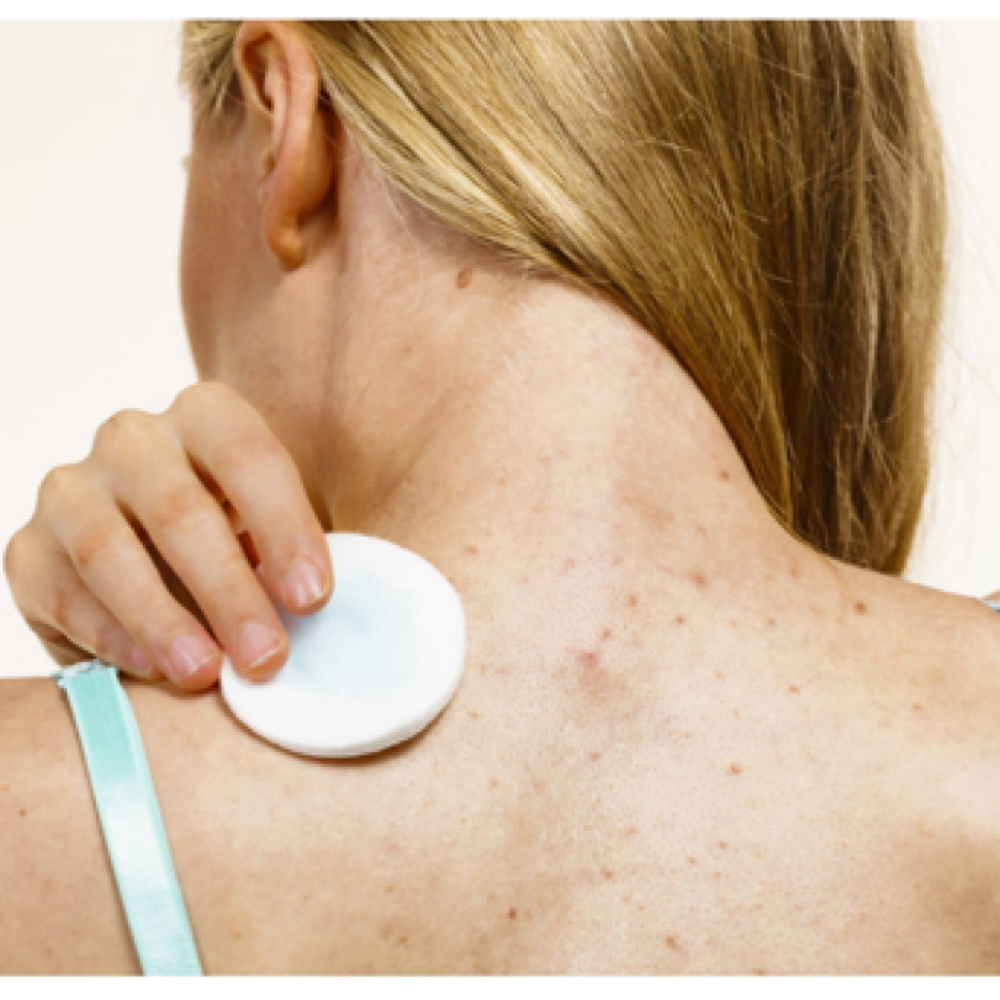 60 min back chemical peel at progressive image salon in pataskala, OH