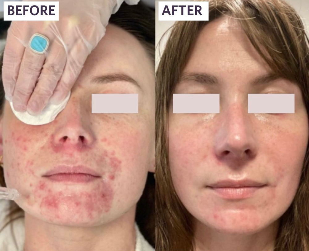 Acne Clearing Facial