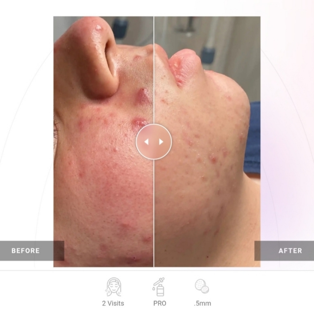 Procell Microchanneling at Akimat Wellness in Bayonne, NJ