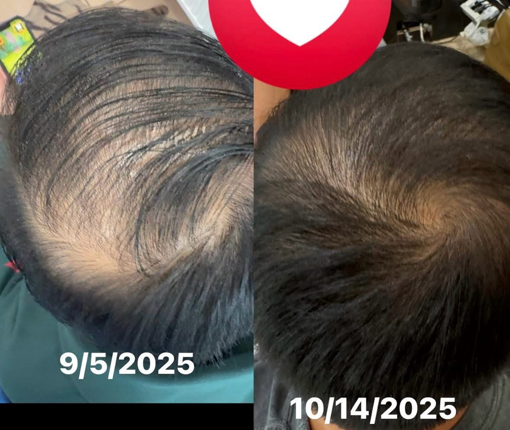 Hair Loss Plasma