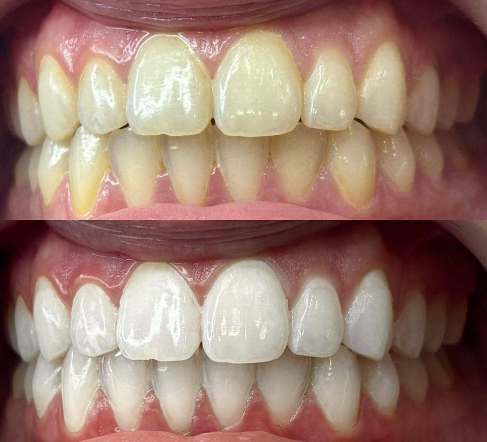 Teeth Whitening 3-n-1 Session