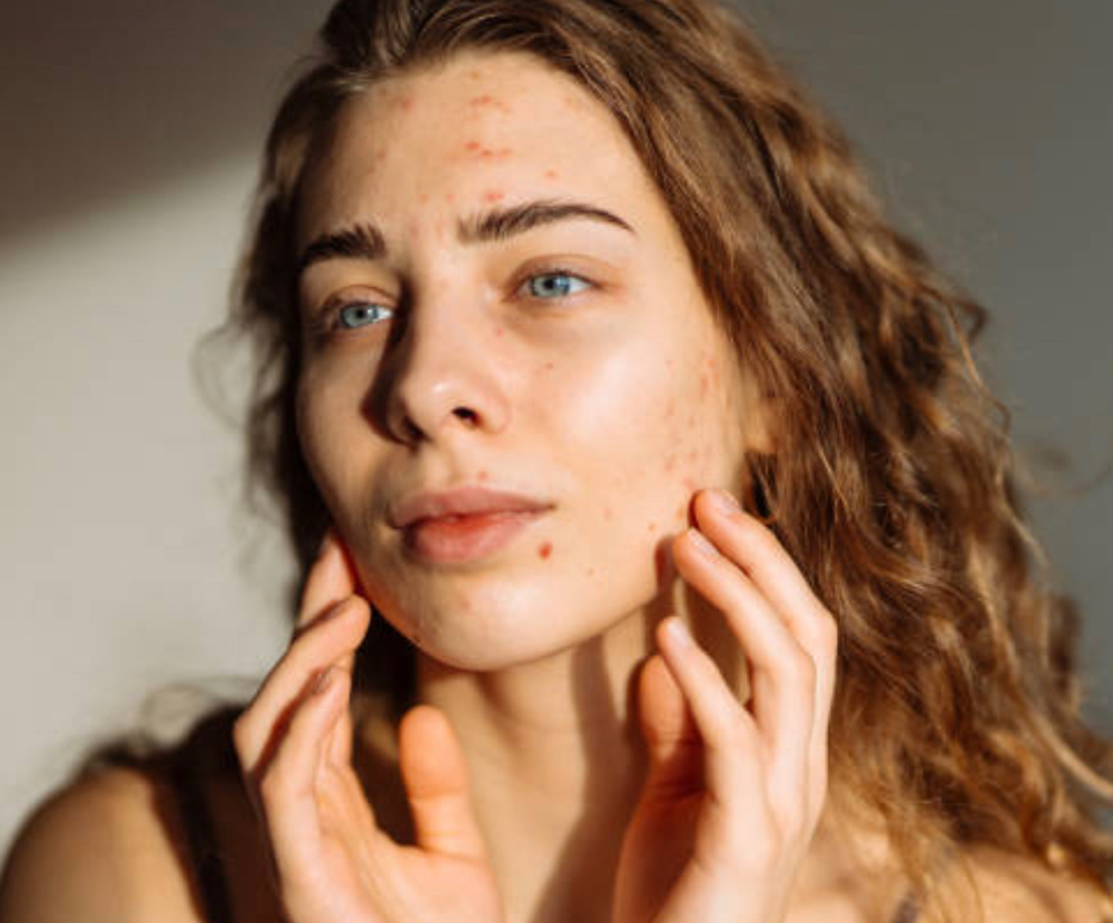 Purifying Acne Facial