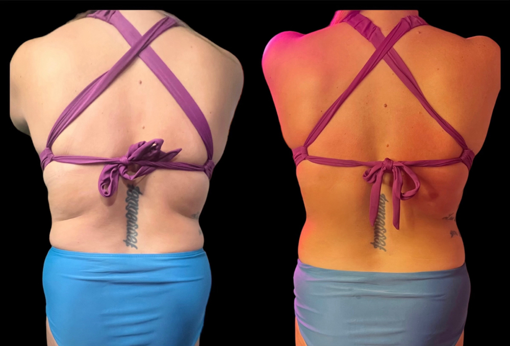 Body Sculpt Back & Bra Roll