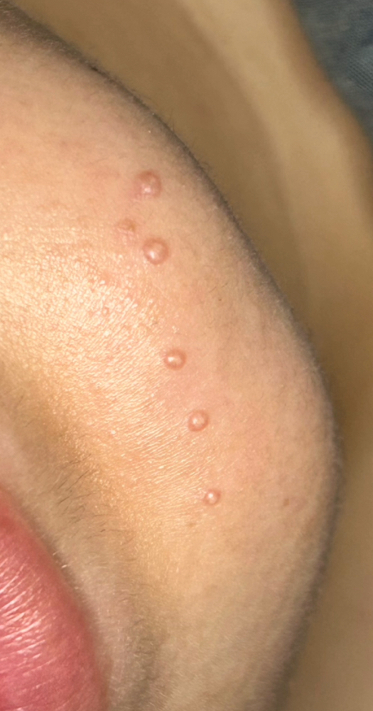 Milia Removal Add On
