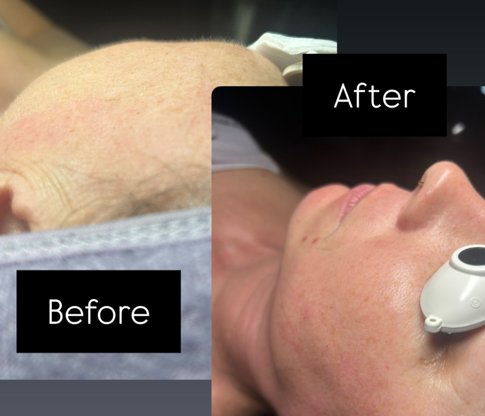 Express Dermaplane - 35 min