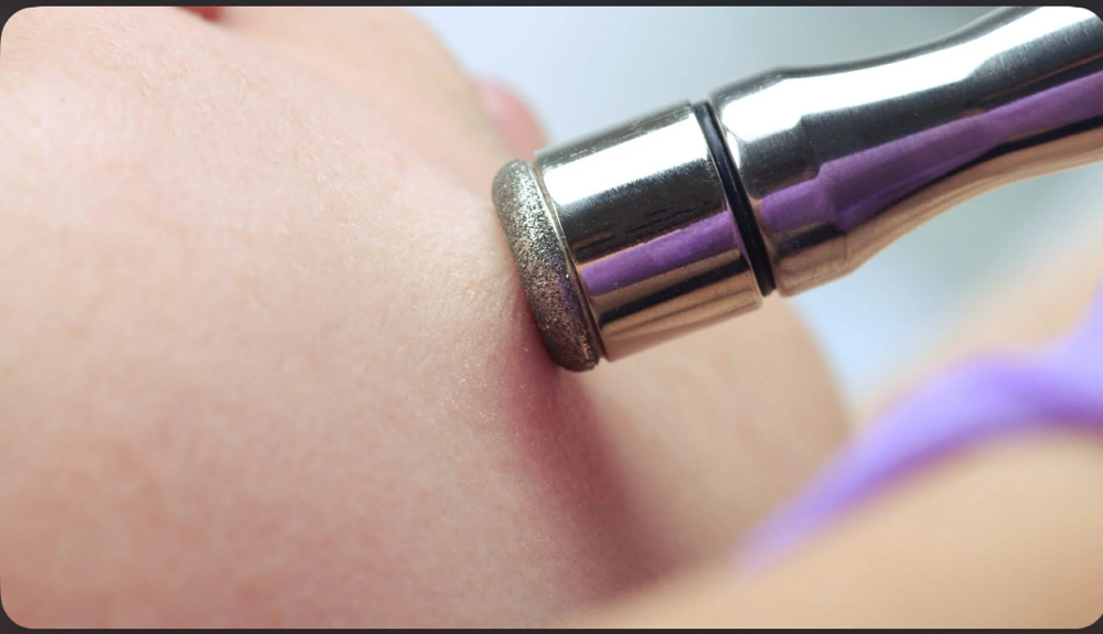 Microdermabrasion at Yesenia Venegas in Chicago, IL