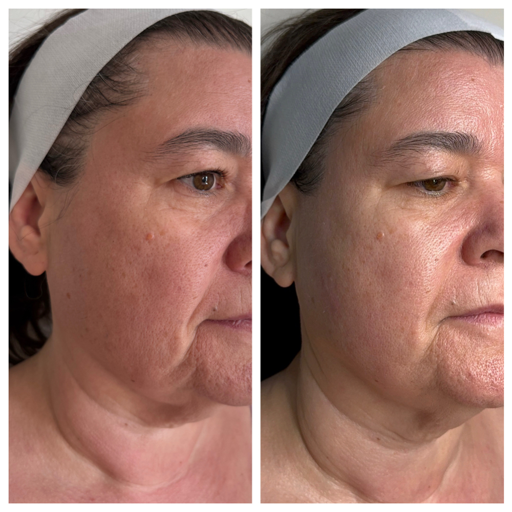 HIFU Skin Lifting & Tightening