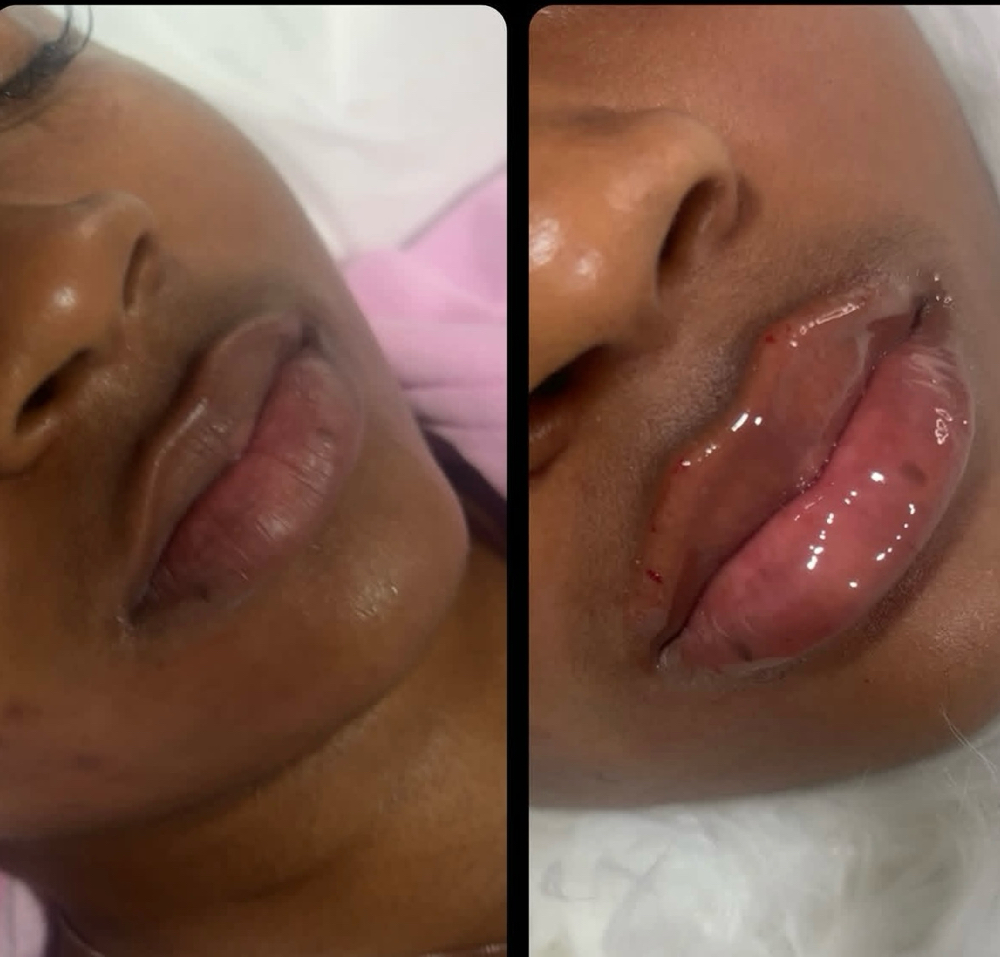 Lip Filler