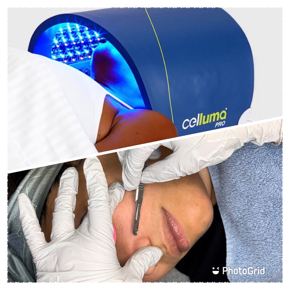 Dermaplane And Light Therapy