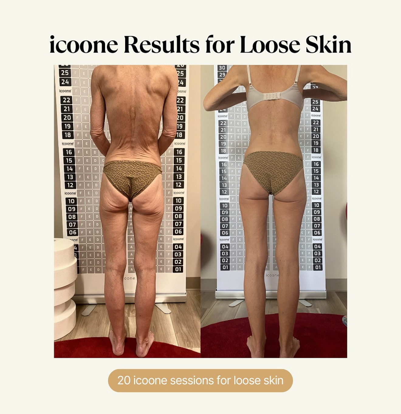 5-Pack CryoSlimming/CryoToning
