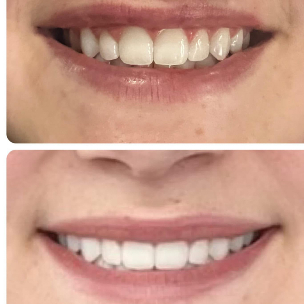 Gummy Smile Lip Flip at Elevate Skin Lab in Desloge, MO