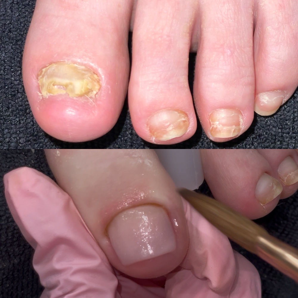 Big Toe Reconstruction