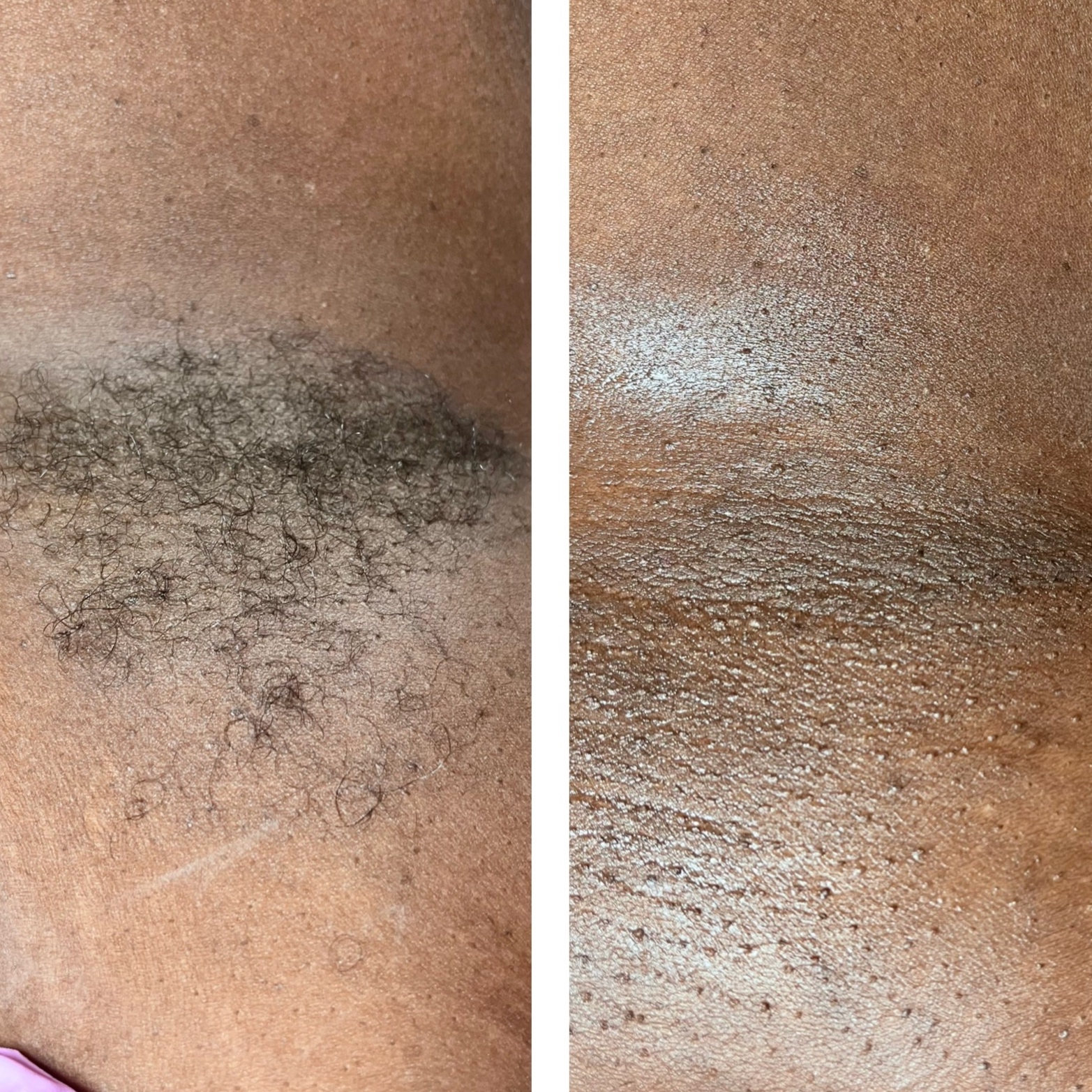 Underarm Wax at The Complexion Parlor in Georgetown, SC