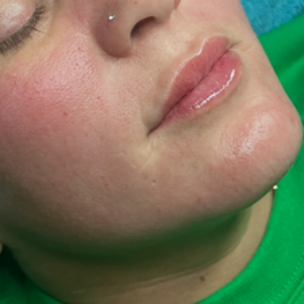 Chemical Peels at Southern Sparkle Medical Aesthetics in Swainsboro, GA