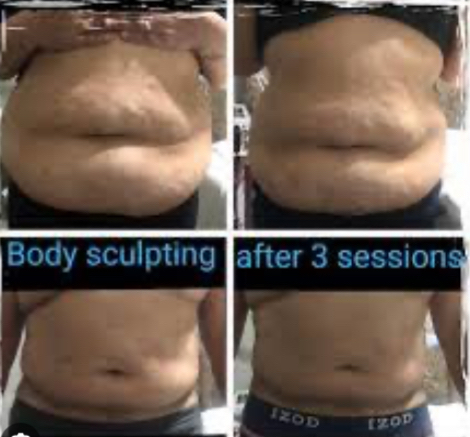 Lipo Cavitation (Belly)