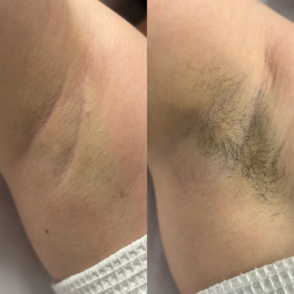 Underarm Wax