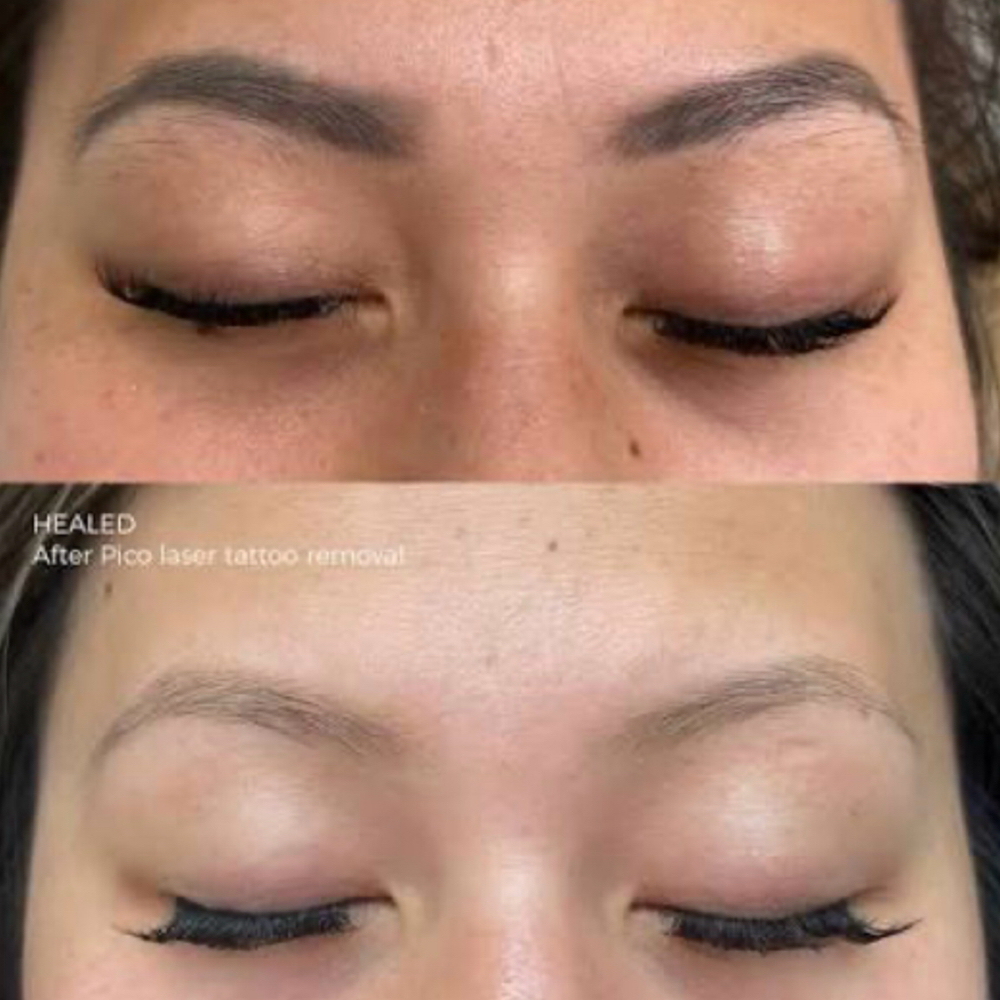 Permanent Make Up Removal at Skin Lab Laser in North Myrtle Beach, SC